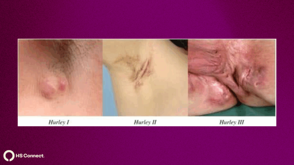 Image shows the three hurley stages of Hidradenitis Suppurativa 