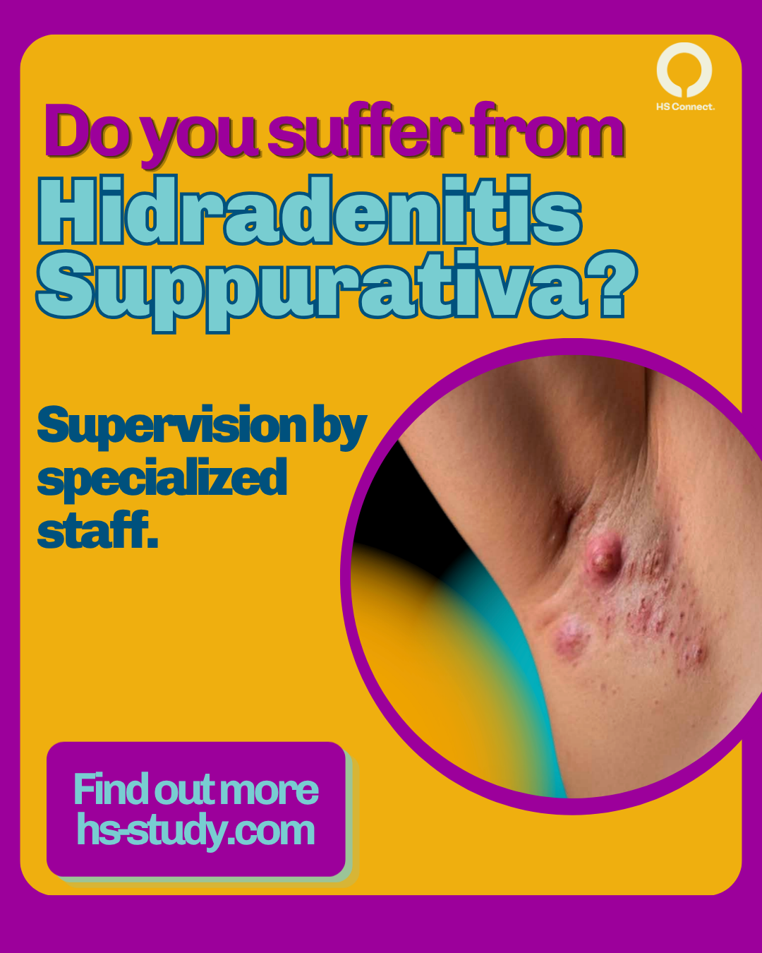 Clinical trial opportunity for hidradenitis suppurativa in Canada